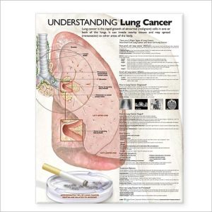 Understanding Lung Cancer Anatomical Chart - Image 6