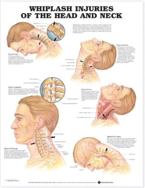 Whiplash Injuries of the Head and Neck Anatomical Chart - Image 3