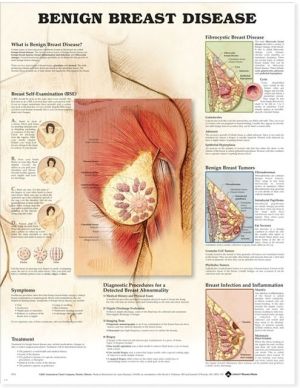 Benign Breast Disease Anatomical Chart - Image 5