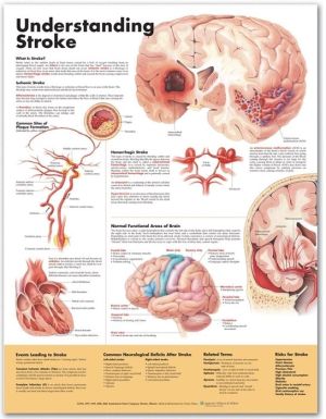 Understanding Stroke Anatomical Chart - Image 6