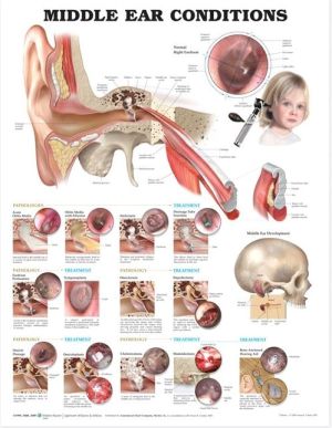 Middle Ear Conditions Anatomical Chart, 2e - Image 4